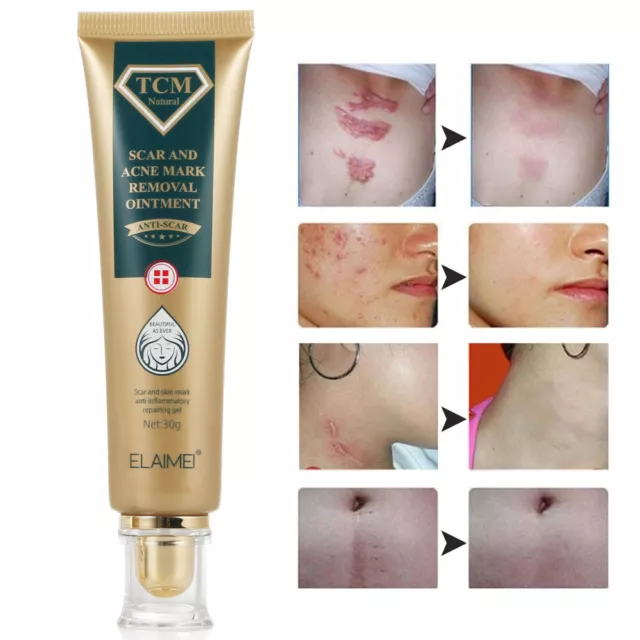 Scar removal Cream Skin Care for Scars Reduce Surgery Acne Stretch Marks