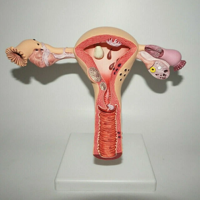 HUMAN FEMALE MEDICAL Anatomy Pathological Uterus and Ovary Anatomical ...