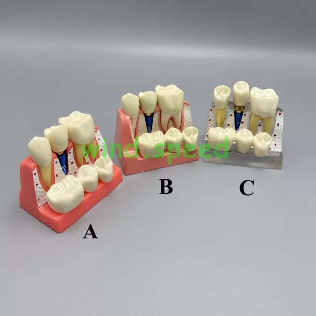 Dental Demonstration Removable Teeth Model Implant Analysis Crown Bridge Study