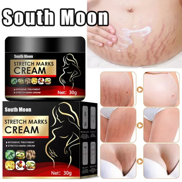 Stretch Marks Removal Cream Pregnancy Scar Cuts Burns Skin Care Repair Cream UK