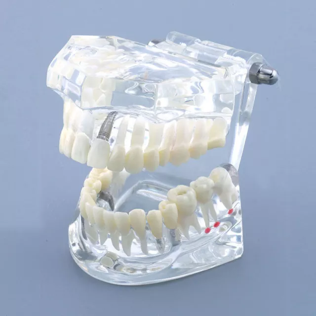 Typodont Teeth Dental Implant Model Restoration Demo Study Analysis Transparent