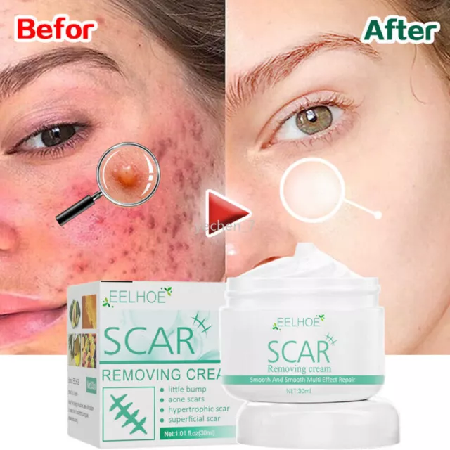 Effective Acne Scar Removal Cream Stretch marks Treatment Skin Whitening Care US