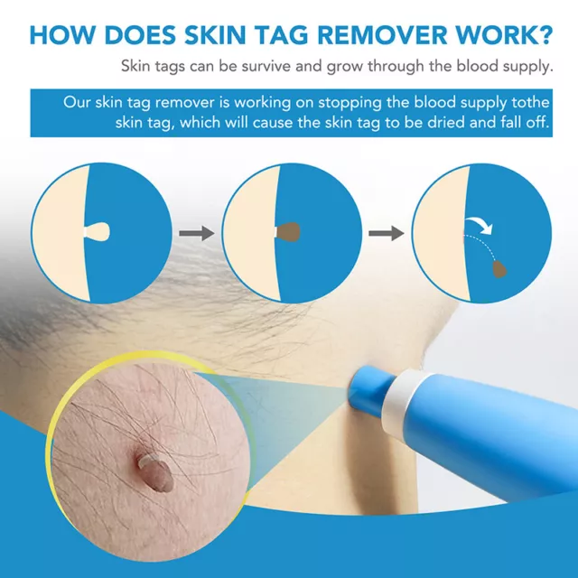 Natural Painless Auto SKIN TAG Removal kit Skin tag bands Remover Device New