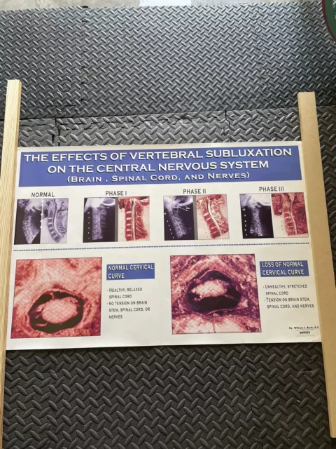 3x Spinal degeneration posters 36”x24”