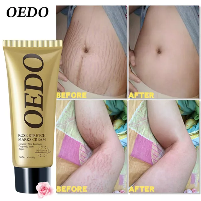 40g Pregnancy Repair Cream Anti Wrinkle Anti Aging Maternity Body Creams Y4