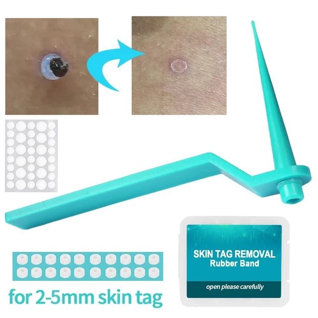 Kit de eliminación de etiquetas de piel Easy Steps 20 piezas anillos de goma incluidos para todas las etiquetas de la piel