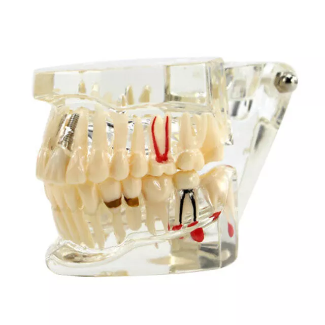 Dental Implant Disease Study Teaching Teeth Model Restoration Bridge Tooth Analy