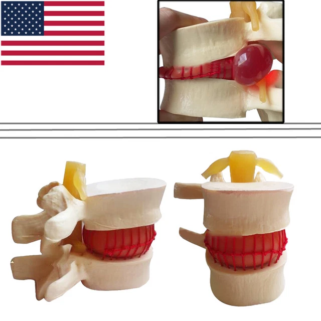 11.5 MEDICAL SPINE Lumbar Disc Herniation Model Demonstration Teach