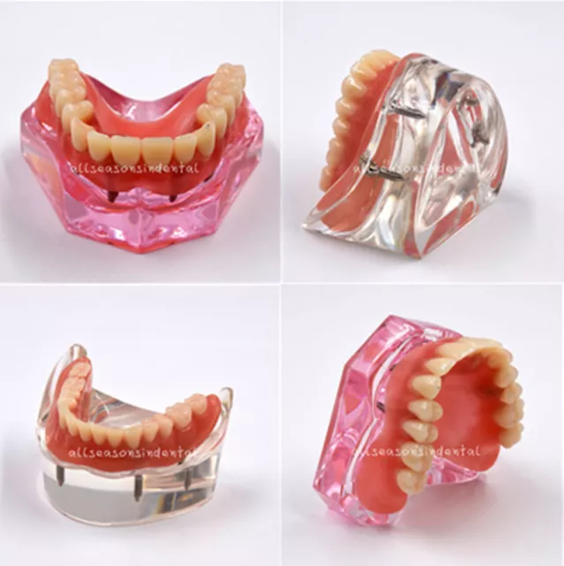 Dental Restoration Model Overdenture Inferior Teeth #6001/ #6003 With 4 Implants