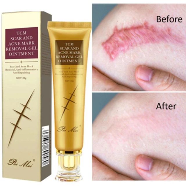 ✅30g Acne Scar Removal Cream Pimples Stretch Marks Nice Gel Remove T0X9