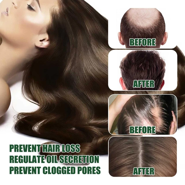 Regrow 7 días jengibre crecimiento del cabello germinal suero pérdida de cabello tratamiento de apósito T0N3