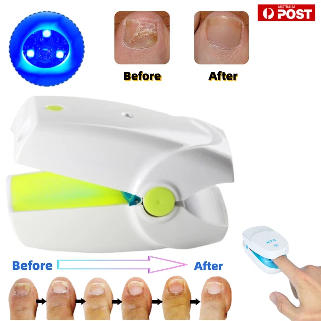 NAIL FUNGAL INFECTION Laser Device Treatment Paronychia Toenail Care