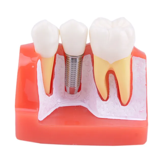 4 Times Dental Démonstration à dents Modèle de dents d'implant dentaire 3