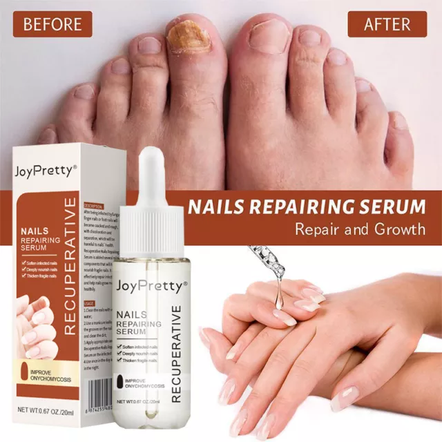 Solución de reparación de hongos en las uñas para curar dedos y dedos de los pies cuidado inflamación 🙂