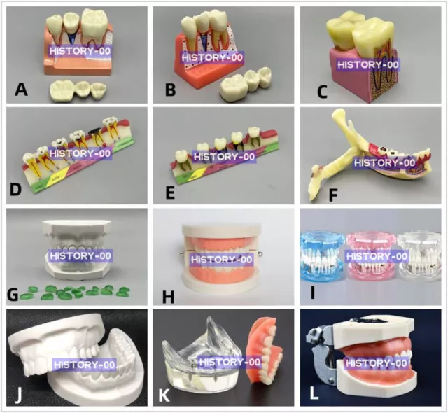 Dental Implant Model Teeth Caries Disease Teaching Study Analysis Demonstration