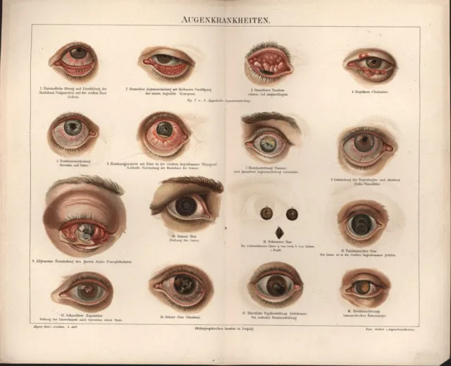 Original Chromolithographie von 1885. Augenkrankheiten