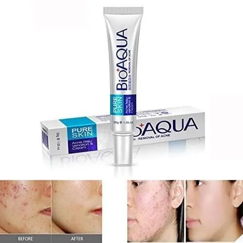 BIOAQUA Crema anti-acne per la rimozione delle cicatrici, per il controllo...