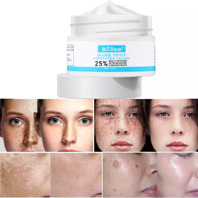 Strong Removal Melasma Whitening Cream Freckle Speckle Sunburn Spots Pigment