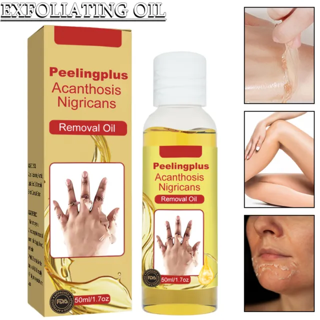 Acanthosis Nigricans Removal Peeling Oil Whitening Therapy Dark Spot F