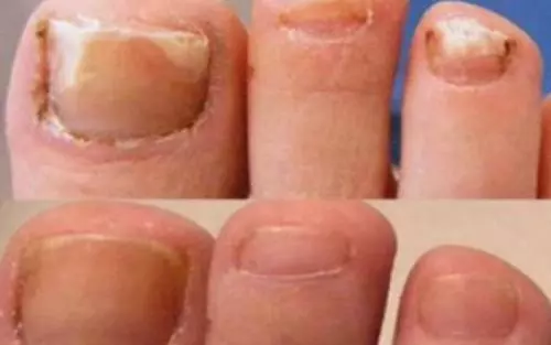 Stronger Fungal treatment lotion kills 99.9% skin nail Fungus toes FOOT & HAND