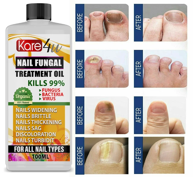 ANTI FUNGAL TREATMENT Fungus Effective Finger Toe Nail Repair Liquid