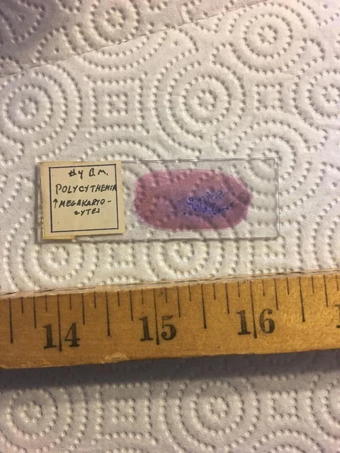 Antique Vintage Microscope Slide  "Polycythemia Megakaryocytes"