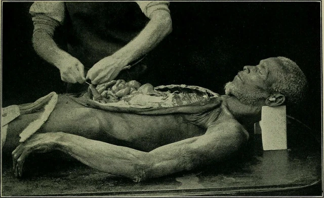 Antique Autopsy Photo 354b Oddleys Strange & Bizarre