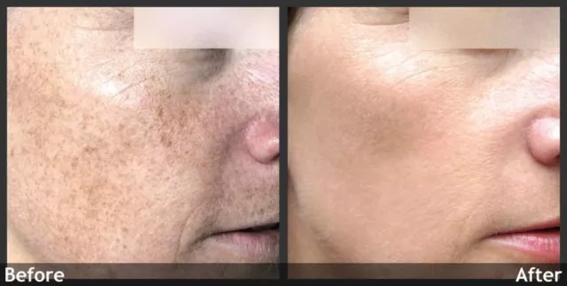 Lactic Acid Skin Peel 40% & Healing Cream & Fan Brush - Professional Results 2