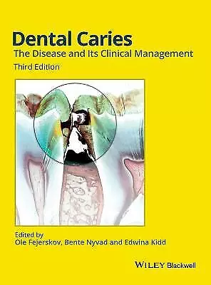 Dental Caries The Disease and its Clinical Managem