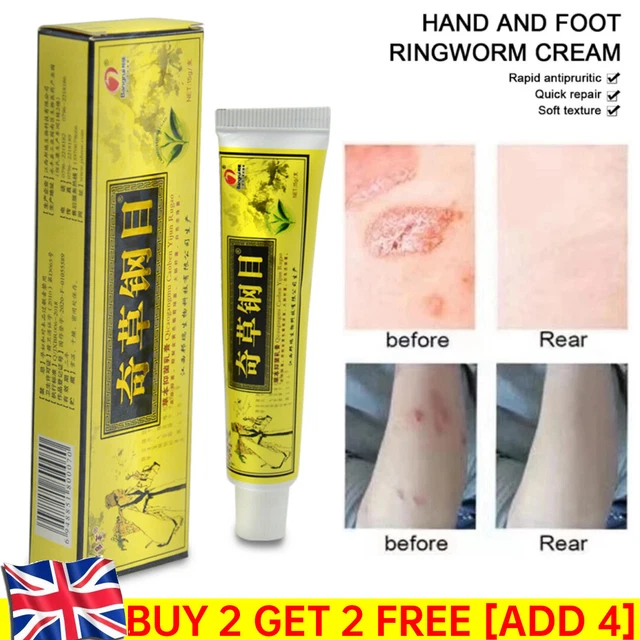 SKIN PSORIASIS CREAM Dermatitis Eczematoid Eczema Ointment Scalp