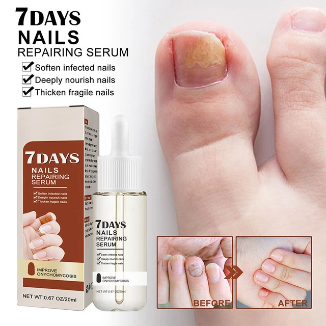 Pilze Maniküre Nagel Hell Serum Reparatur Öl Zehennagel Care Recover Gesundheit