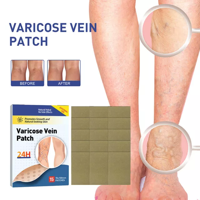 1Bag 10 Patches Varicose Veins Plaster Medical Patch Vasculitis Spider Leg  Care