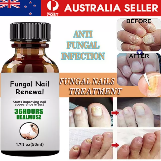 Nail Ingrown Repair Solution Anti-Infection Onychomycosis Paronychia Repair