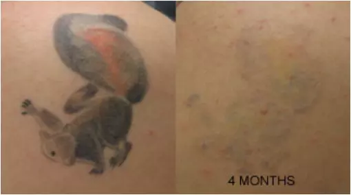 Tattoo Removal Cream Fading system wrecking balm 12 month 1 glove 2