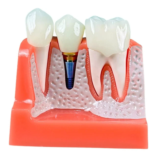6x Dentistry Students Practice Teeth Models Planting Nail Medical Teaching Kit