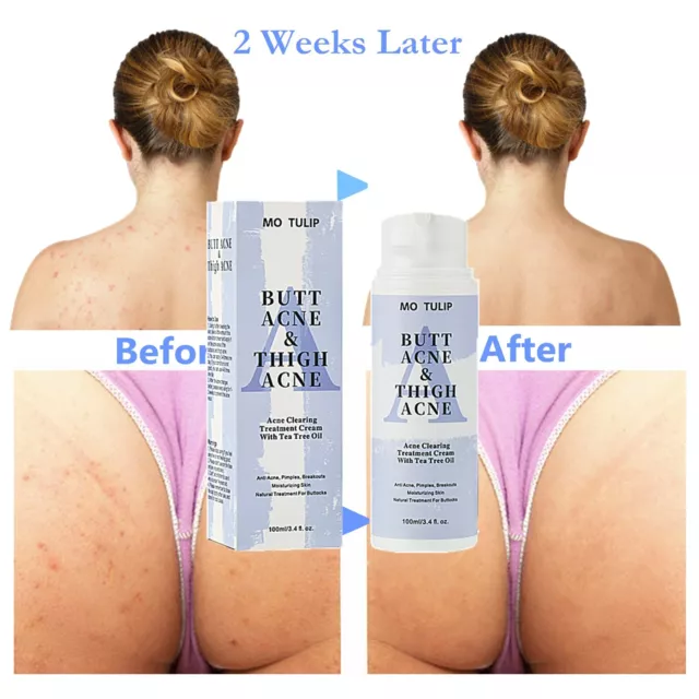 Butt Acne Clearing Spot Treatment Cream Clears Acne Pimple Zits Razor Bump