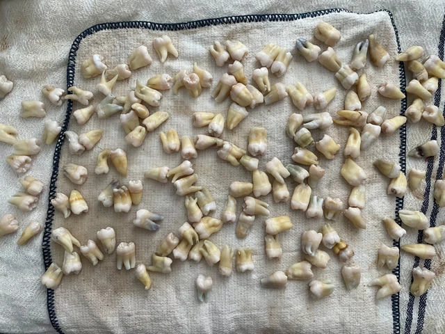 1 Adult Human Tooth, Extracted by a Dentist