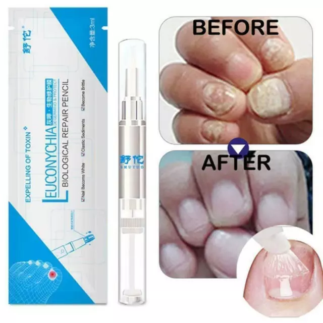 FUNGUS STOP Pencil - Anti Fungal Nail Repair Treatment Fingernails Toenails