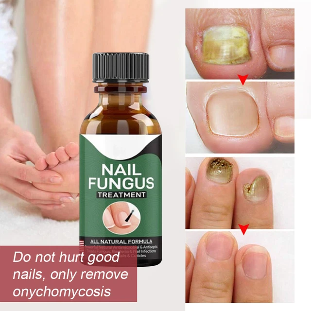 ANTIFUNGAL MAXIMUM STRENGTH Toenail Fungus Athletes Foot Fungi Nail