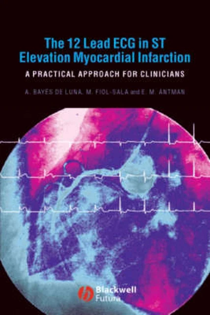 THE 12-LEAD ECG in ST Elevation Myocardial Infarction: A Practical ...