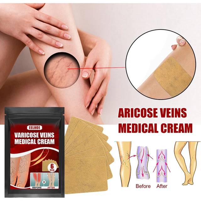 Body Vasculitis Phlebitis Spider Pain Relief Plaster Unisex Health Care Patches 7