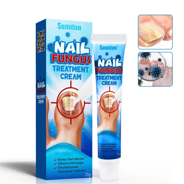 Nail Fungus Treatment Cream Anti-Fungal Onychomycosis Paronychia Nail Repair 20g