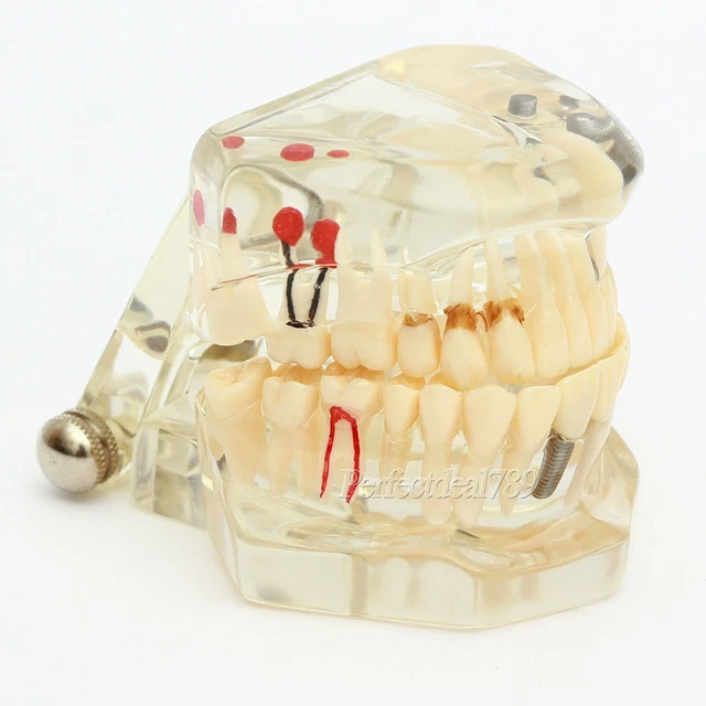 Dental Implant Disease Study Teachin Teeth Model With Restoration & Bridge Tooth