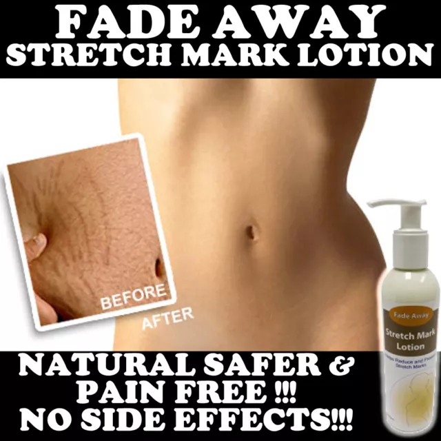 Lozione Fade Away Stretch Mark Crema Max Forza Rimuove Le Smagliature