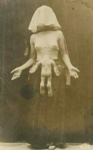 Antique Medical Parasitic Twin Photo 958b Oddleys Strange & Bizarre
