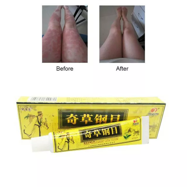 2Pcs 15g Chinese Herbal Cream Itching Treatment Skin Body/Foot Allergy Ointment