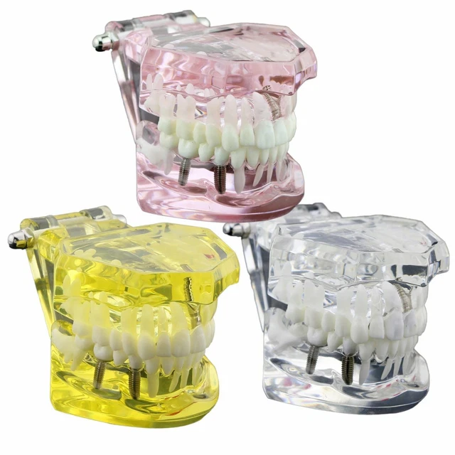 Dental teeth model disease study implant restoration teaching bridge