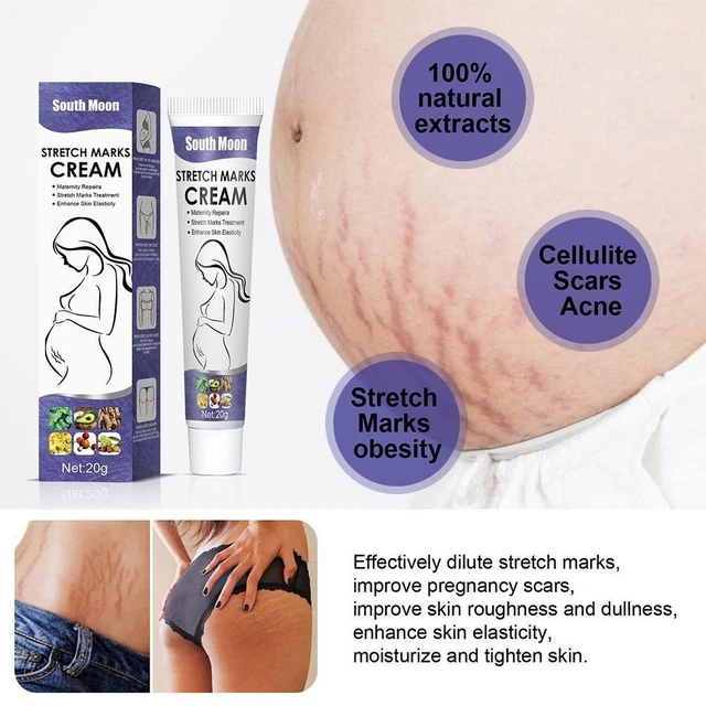 Crema de eliminación de estrías 20 g para eliminar maternidad J3JXRE crema para la piel T4S2