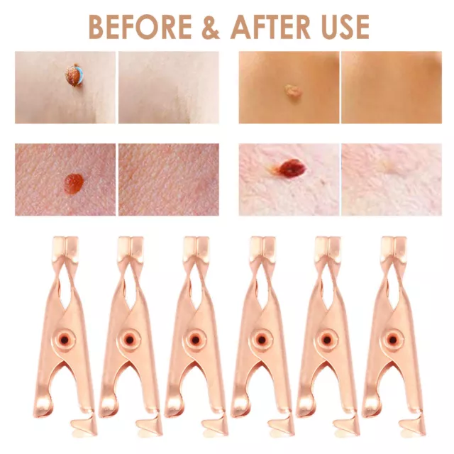 warts skin tag remover clip 12pcs warts remove flesh moles with warts