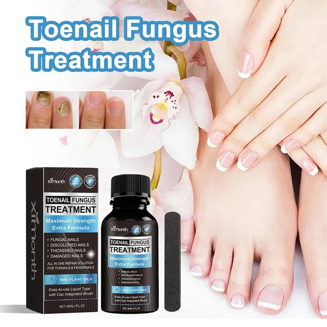 NAIL TREATMENT ESSENCE Toenail Fungus Repair Foot Anti Infection Fungal